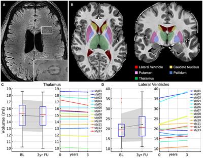 Iron Rims in Patients With Multiple Sclerosis as Neurodegenerative Marker? A 7-Tesla Magnetic Resonance Study